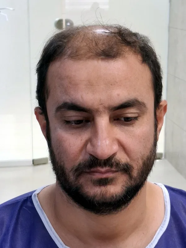 قبل از کاشت مو - نمونه ۱