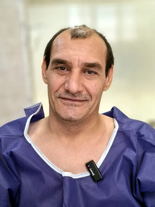 قبل از کاشت مو - نمونه ۴